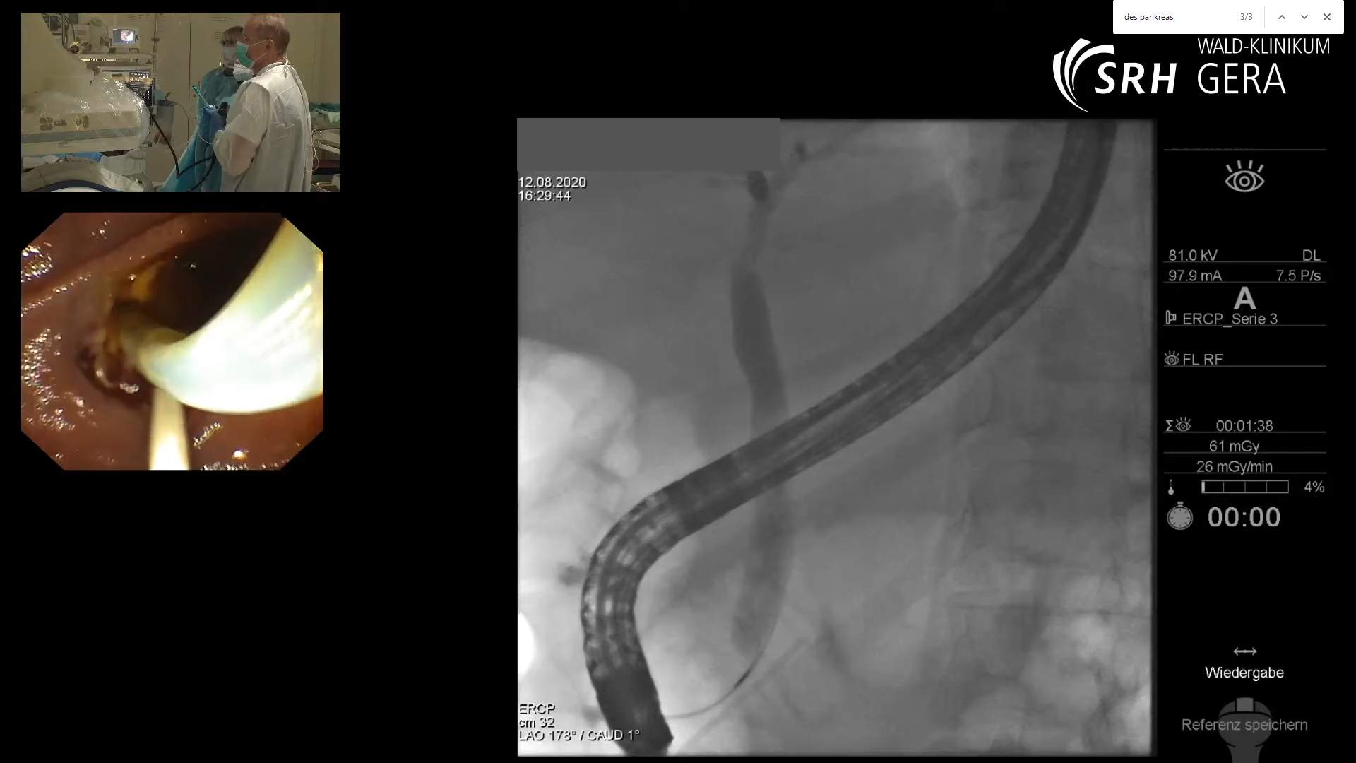 ERCP mit Precut, Papillotomie, Steinextraktion und Einlage eines ...