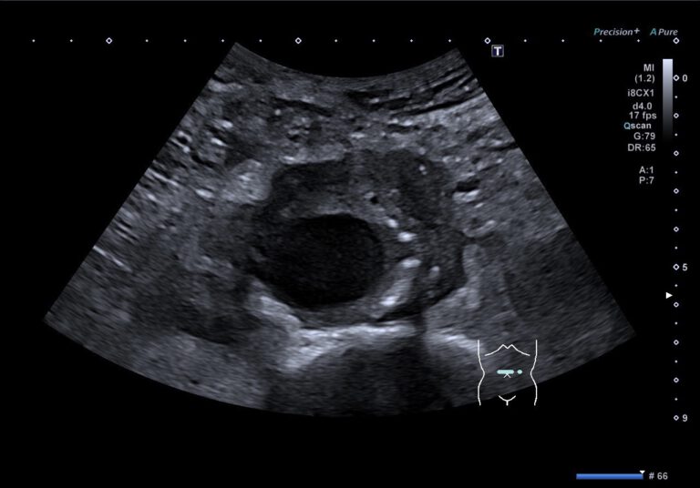 Ummauerung der Aorta abdominalis