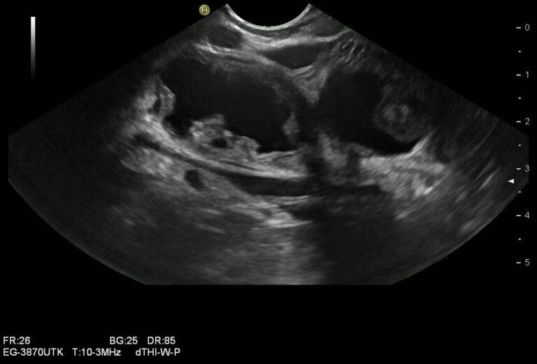 IPMNIPMN, Intraduktale papillär-muzinöse Neoplasie, Endosonographie, Pankreastumor, zystischer Pankreastumor, Doppelgangzeichen